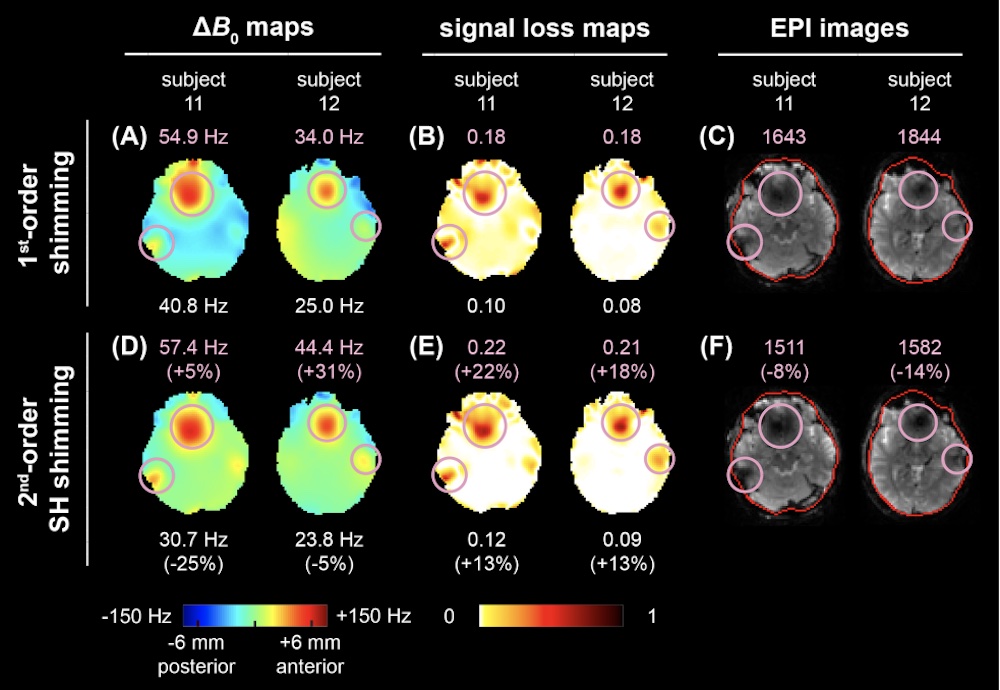 Application of an integrated radio-frequency/shim coil technology for signal recovery in fMRI